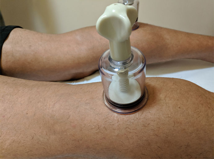 masaje de drenaje linfático en Badajoz utilizando ventosas